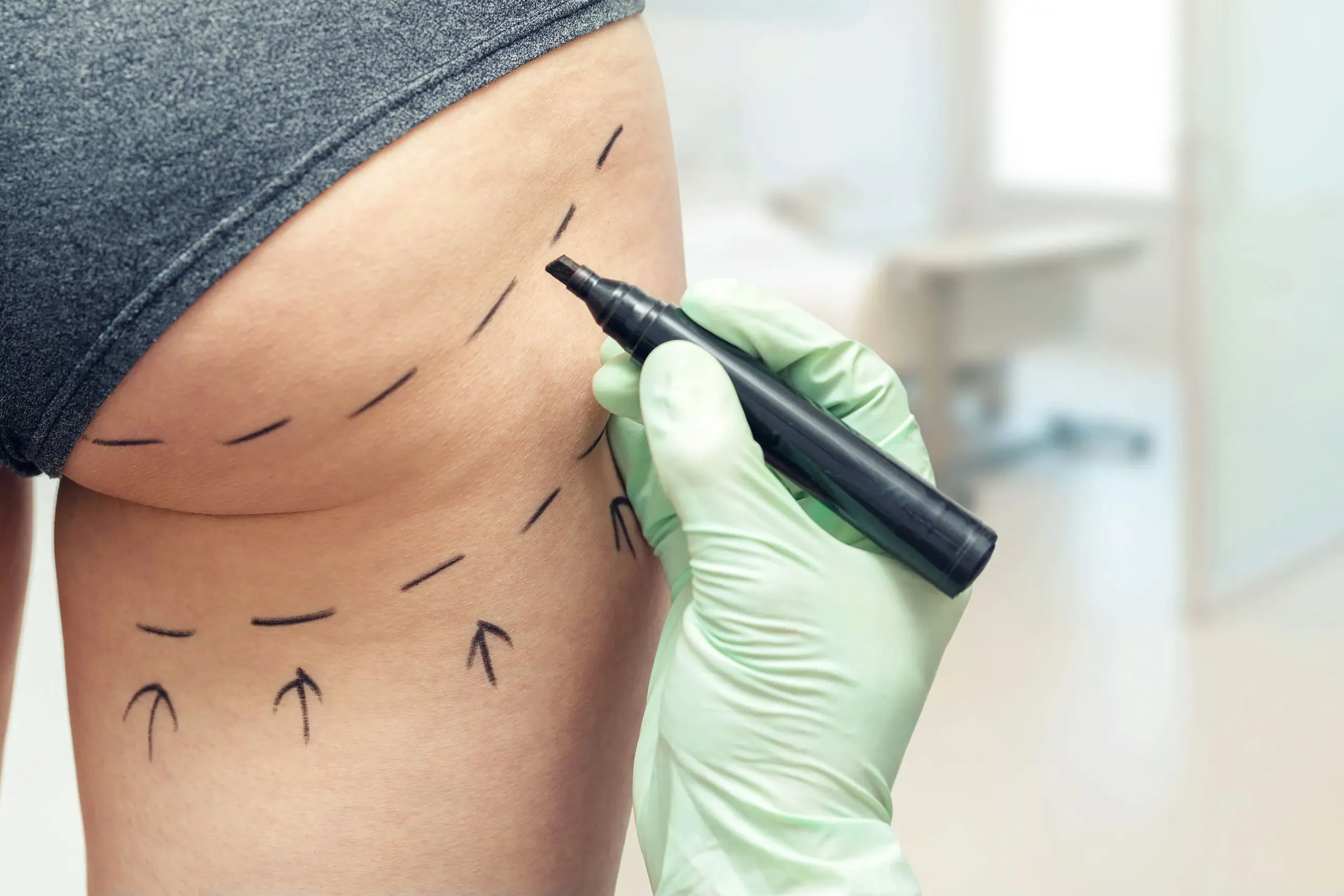 Descifrando el Enigma de la Liposucción en Málaga: Más Allá de la Belleza